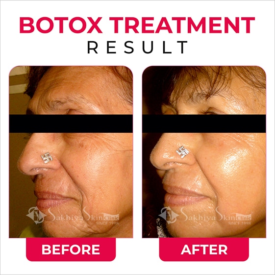 Before and After Results Of Botox Treatment (3)
