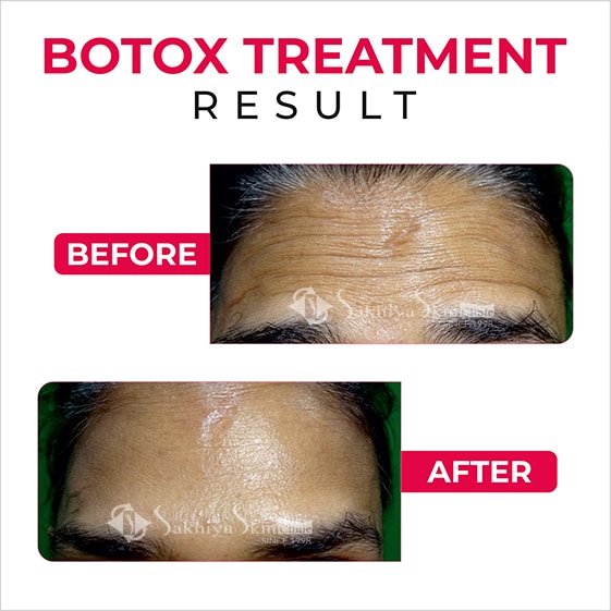 Before and After Results Of Botox Treatment