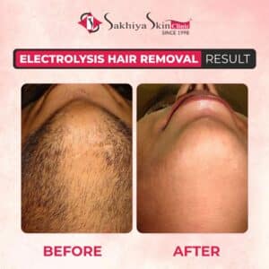 Electrolysis Hair removal-before after 2