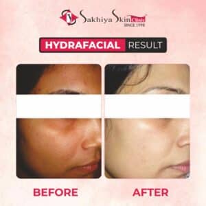 hydrafacial-before after 2