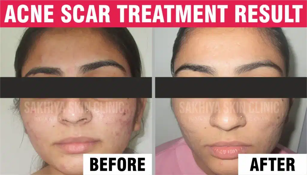 Acne Scar Treatment Before And After