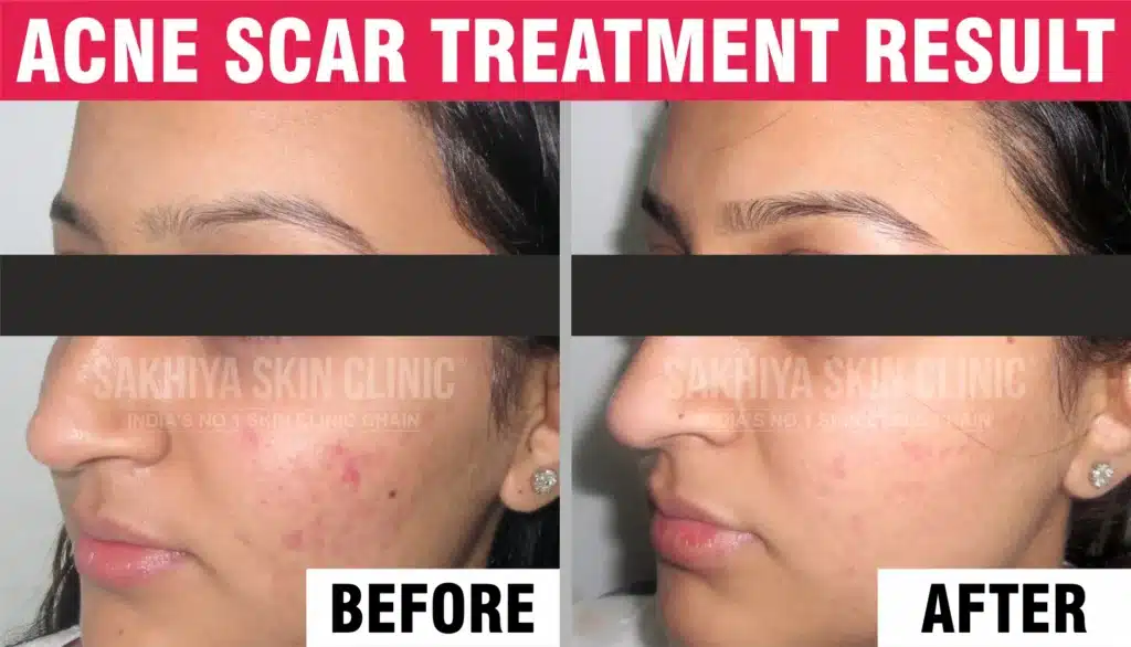 Acne Scars Treatment