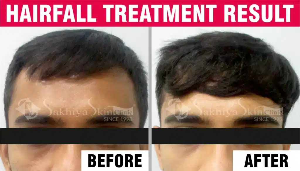 Google Review Youtube (Before After) Hairfall 01