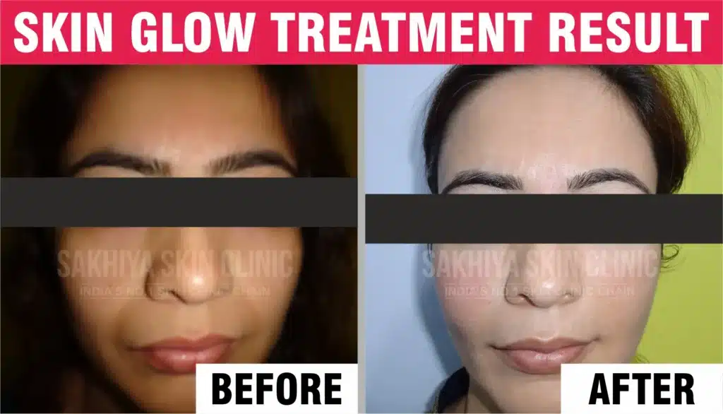 Skin Glow Before And After Result
