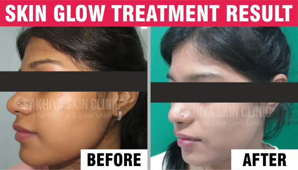 skin glow and freckle treatment