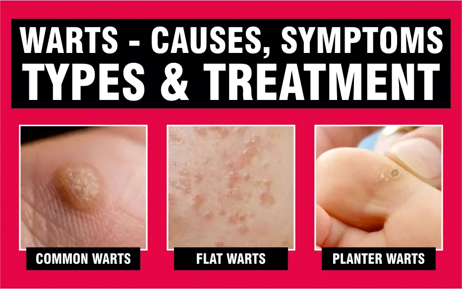 Warts removal